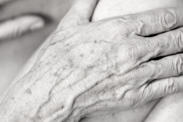 Age Spots removal on the hands by cryosonic Leighton Buzzard