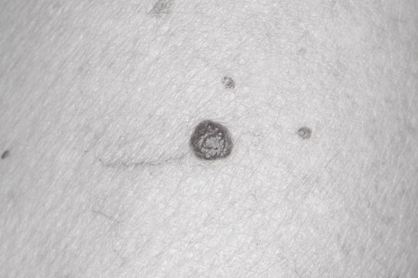 Cherry Angioma Post-Treatment Care for Best Results Leighton Buzzard