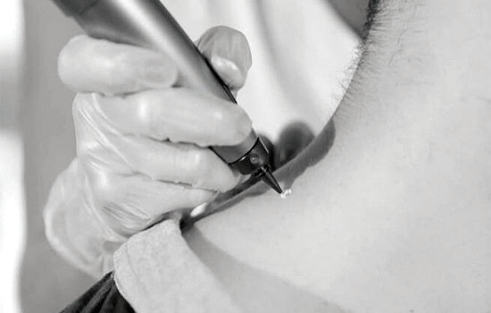 Benign Mole Possible Reactions and How Common They Are Leighton Buzzard