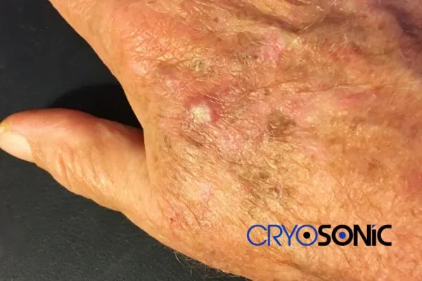Book Your Actinic Keratosis removal Leighton Buzzard treatment Today Leighton Buzzard