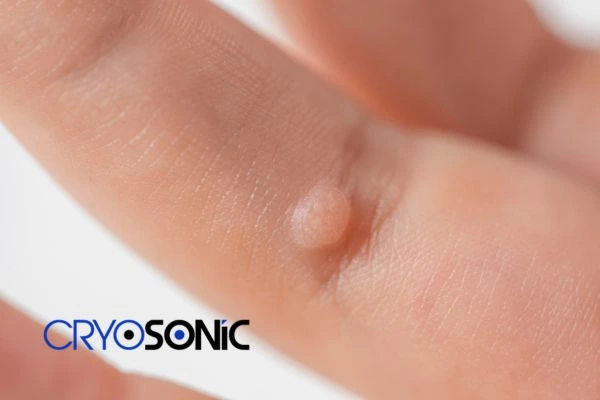 Contact Cryosonic today to learn more about us Leighton Buzzard now! Leighton Buzzard