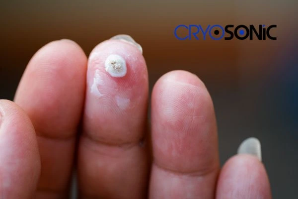 Learn more about us Leighton Buzzard at Cryosonic. Book in today! Leighton Buzzard