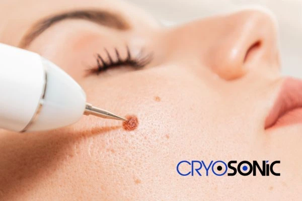 why choose us at Cryosonic for blemish removal? Find out more now Leighton Buzzard