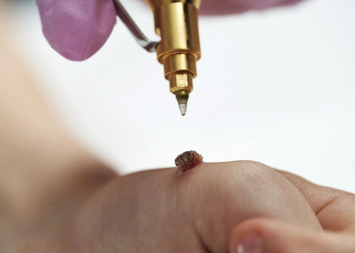 Cryopen For Children Bristol Leighton Buzzard