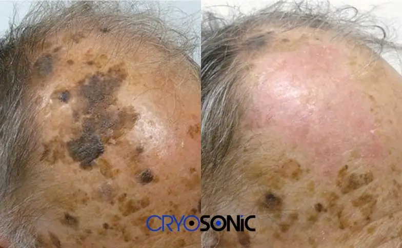 Seborrhoeic Keratosis Removal before and after Leighton Buzzard