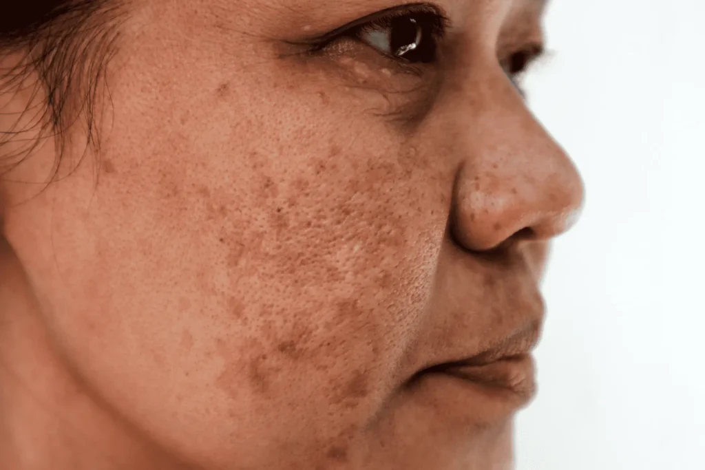 Aftercare Advice for Sun Damage Treatment Leighton Buzzard