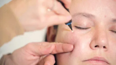 Aftercare Advice Following Milia Removal in Leighton Buzzard