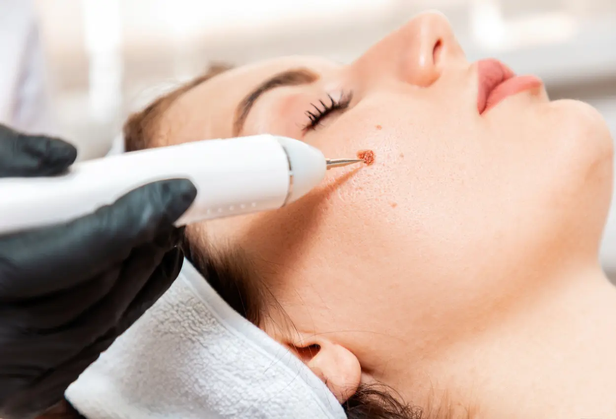 Frequently Asked Questions About Multiple Cryotherapy Treatments Leighton Buzzard