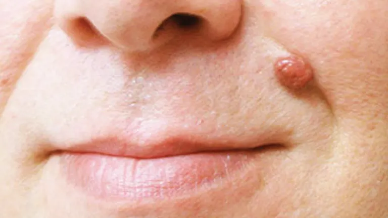 Are There Any Side Effects After removing the Skin Tags? Leighton Buzzard
