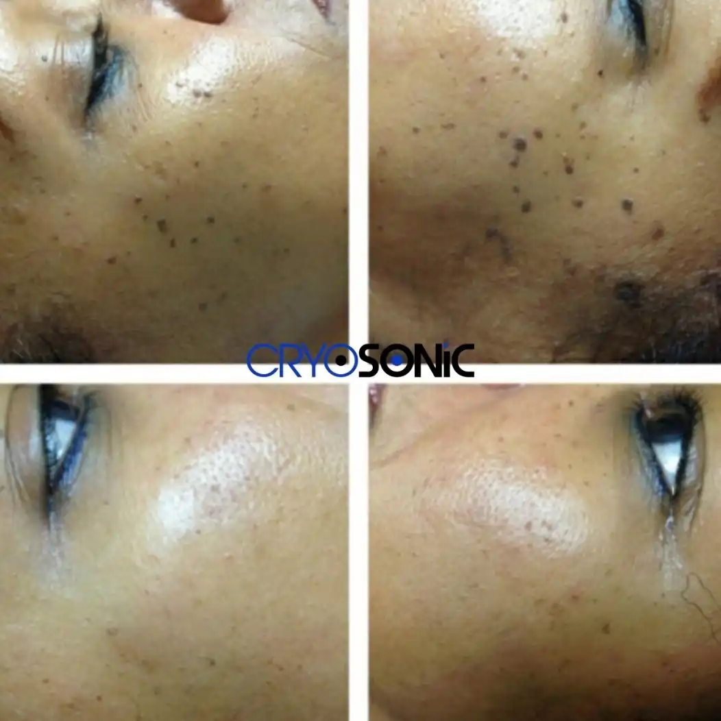 Why Skin Shows Pigmentation After Treatment Leighton Buzzard