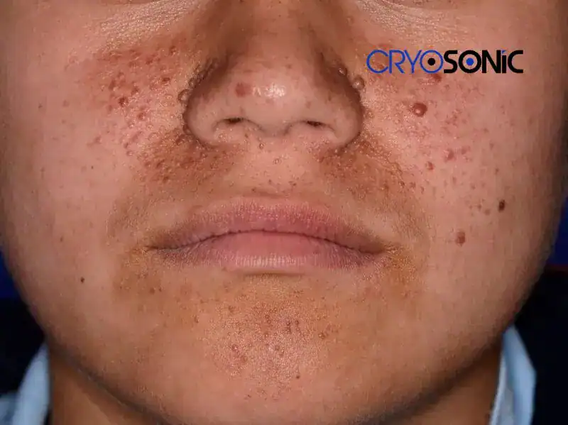 Angiofibroma Possible Side Effects and Risks Leighton Buzzard