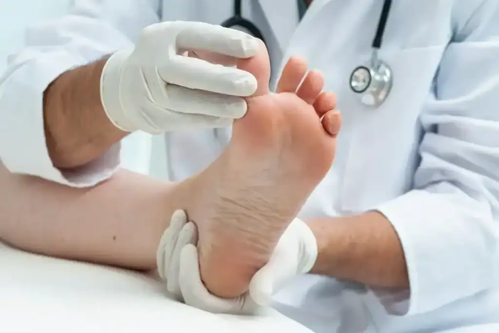 Porokeratosis Removal Treatment Leighton Buzzard