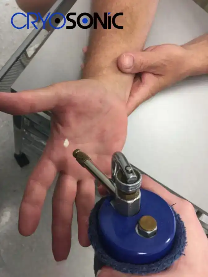 Temperature Differences: OTC vs Medical-Grade Cryotherapy Leighton Buzzard